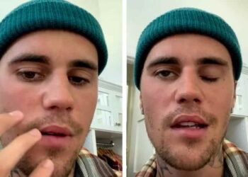 justin tiene paralisis facial
