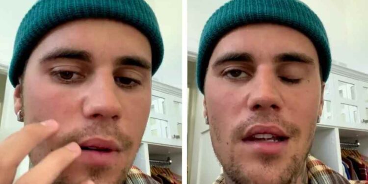 justin tiene paralisis facial